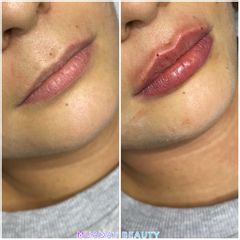 Aumento de labios - Muaqat Beauty