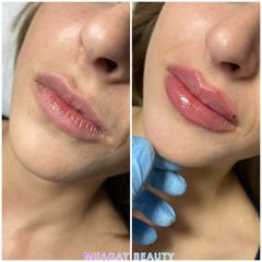 Aumento de labios - Muaqat Beauty