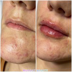 Aumento de labios - Muaqat Beauty