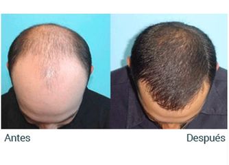 Antes y después Implantes de pelo
