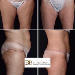 CoolSculpting - Dra. Beatriz Beltrán