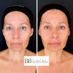 Rellenos faciales - Dra. Beatriz Beltrán