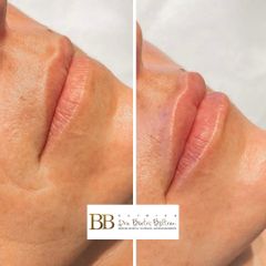 Aumento de labios - Dra. Beatriz Beltrán