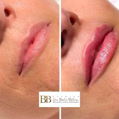 Aumento de labios - Dra. Beatriz Beltrán