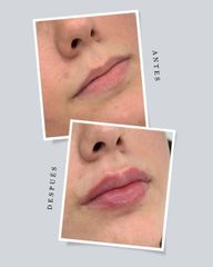 Aumento de labios - BeClinic