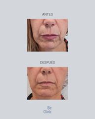 Rellenos faciales - BeClinic