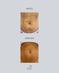 Mesoterapia - BeClinic
