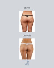 Mesoterapia - BeClinic