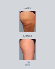 Mesoterapia - BeClinic