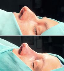 Rinoplastia - Dra. Andrea Vicente