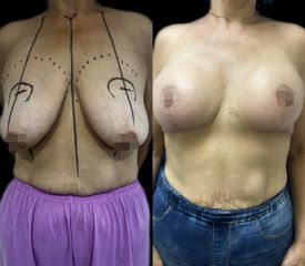 Mastopexia - Dra. Andrea Vicente