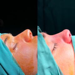 Rinoplastia - Dra. Andrea Vicente