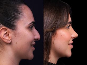 Rinoplastia antes y después - 877217