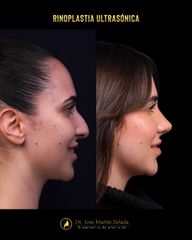 Rinoplastia Alicante Dr. Martin Zelada
