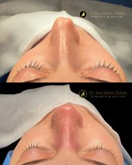 Rinoplastia en Alicante, dia 0 Clinica Lessence