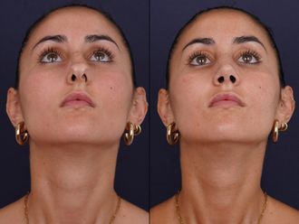 Rinoplastia antes y después - 877219