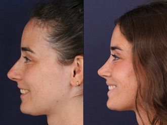 Rinoplastia antes y después - 877221