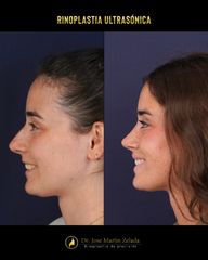Antes y despues rinoplastia Clinica Lessece