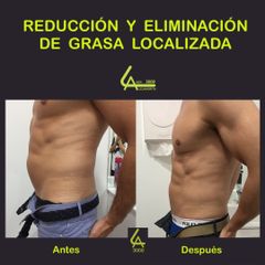 Mesoterapia Corporal - Láser Alejandrita 3000
