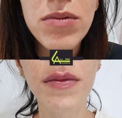 Aumento de labios - Láser Alejandrita 3000
