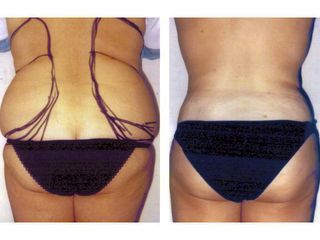 Antes y después Hidrolipoclasia 4D
