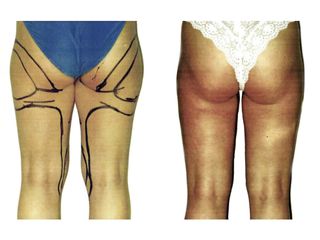 Antes y después Hidrolipoclasia 4D