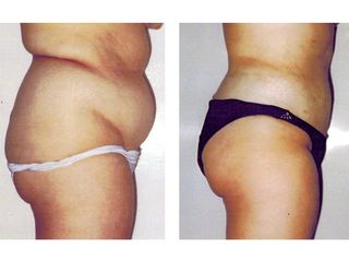 Antes y después Hidrolipoclasia 4D