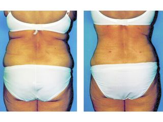 Antes y después Hidrolipoclasia 4D