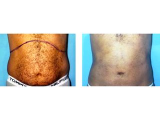 Antes y después Hidrolipoclasia 4D