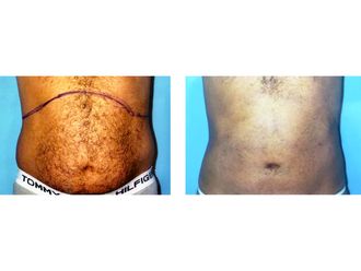 Hidrolipoclasia - 644768