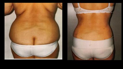 Hidrolipoclasia - Grup Ciscar Clinic