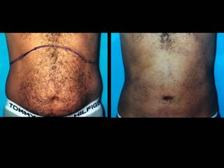 Antes y después Hidrolipoclasia