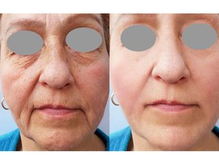 Rejuvenecimiento facial - Grup Ciscar Clinic