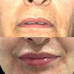 Aumento de labios - Grup Ciscar Clinic