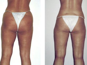 Hidrolipoclasia antes y después - 842123