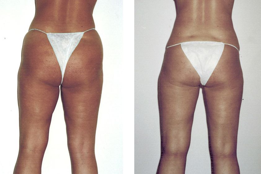 Hidrolipoclasia antes y después - 842123