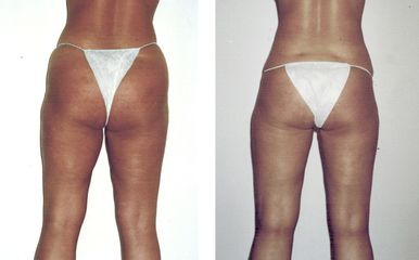 Hidrolipoclasia - Grup Ciscar Clinic