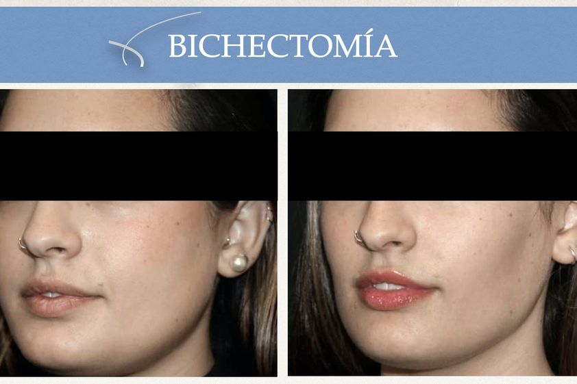 Bichectomía antes y después - 662414