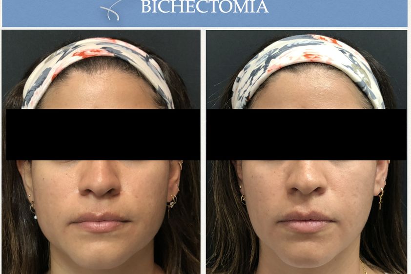 Bichectomía antes y después - 662421