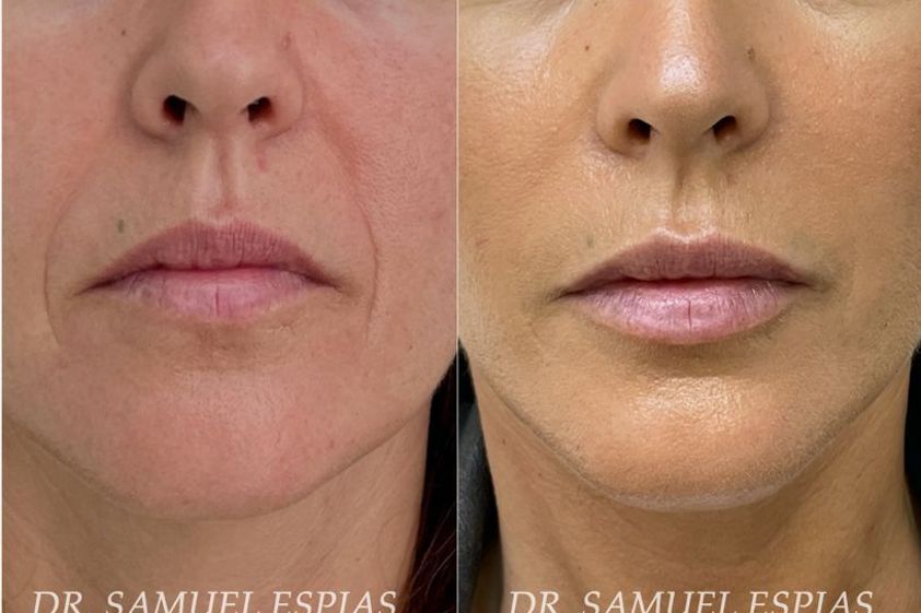 Aumento labios antes y después - 792970