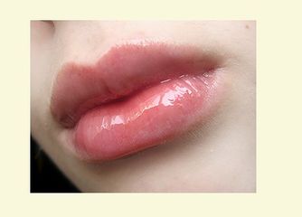 Aumento y perfilado de labios