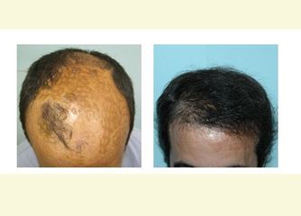 Antes y después Alopecia grado III