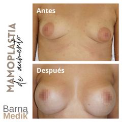 Aumento de pecho - Clínica BarnaMedik