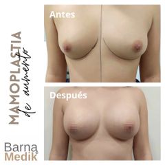 Aumento de pecho - Clínica BarnaMedik