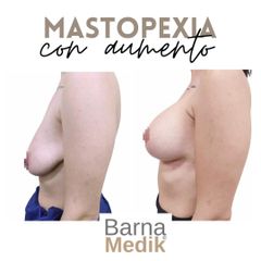 Mastopexia - Clínica BarnaMedik