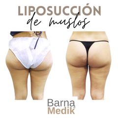Liposucción - Clínica BarnaMedik