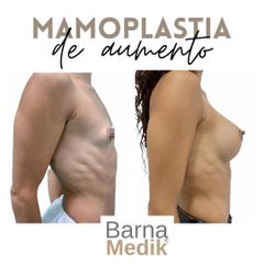 Aumento de pecho - Clínica BarnaMedik