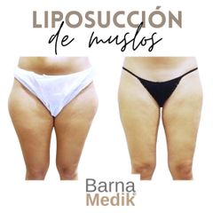 Liposucción - Clínica BarnaMedik