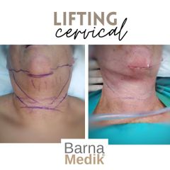 Lifting cervical - Clínica BarnaMedik