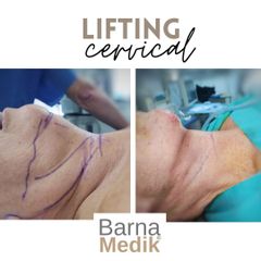 Lifting cervical - Clínica BarnaMedik